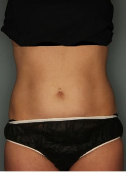 CoolSculpting to the Flanks