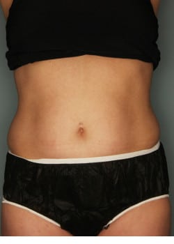 CoolSculpting to the Flanks