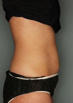 CoolSculpting to the Flanks