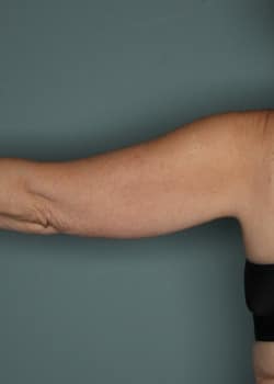 CoolSculpting to Arms