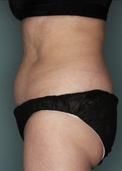 CoolSculpting to Abdomen & Flanks