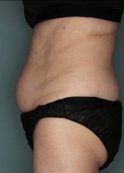 CoolSculpting to Abdomen & Flanks