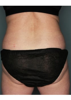 CoolSculpting to Flanks and Bra Fat