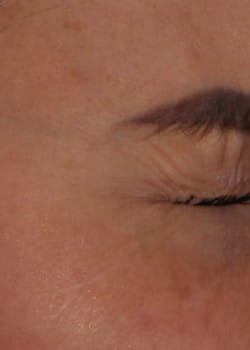 Botox for Crow’s Feet