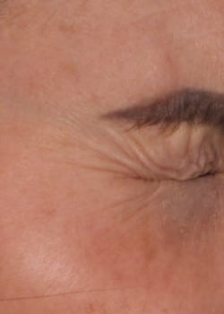 Botox for Crow’s Feet