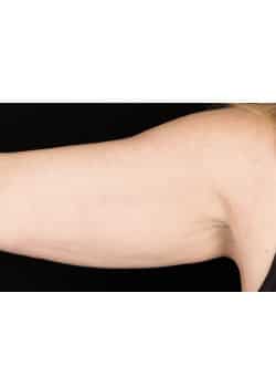 CoolSculpting to the Arms