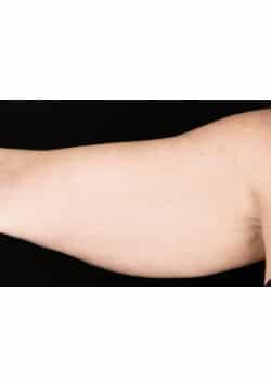 CoolSculpting to the Arms