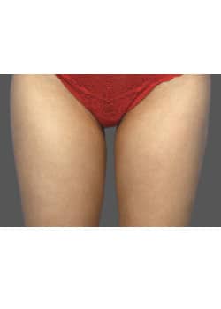 CoolSculpting to Inner Thighs – Before & After