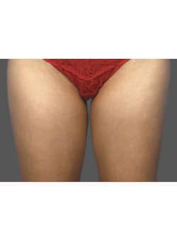 CoolSculpting to Inner Thighs - Before & After Before & After