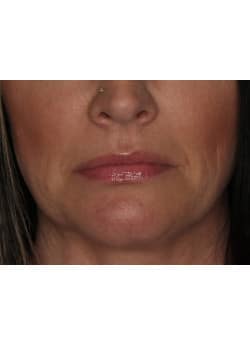 Botox for Frown Lines