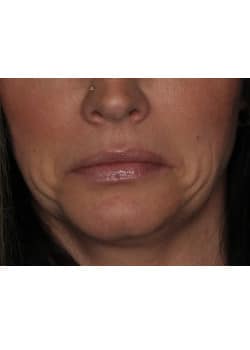 Botox for Frown Lines