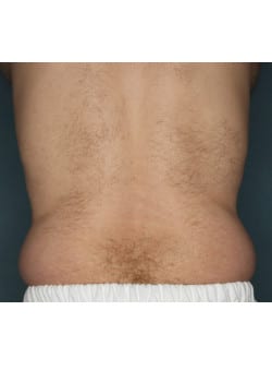CoolSculpting to Flanks