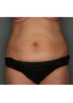 CoolSculpting to the Abdomen & Flanks
