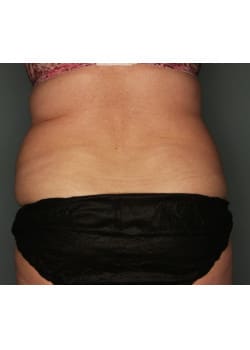 CoolSculpting to the Abdomen & Flanks