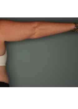 CoolSculpting to Arms