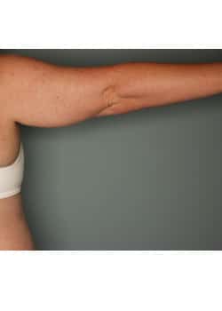 CoolSculpting to Arms