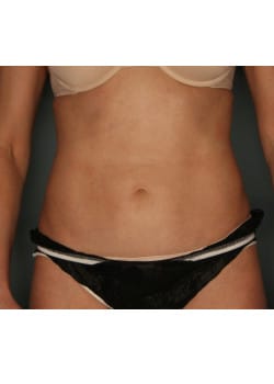 CoolSculpting to Abdomen and Flanks