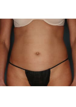 CoolSculpting to Abdomen and Flanks