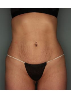 Abdominoplasty – Before & After – 3