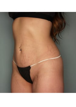 Abdominoplasty – Before & After – 3