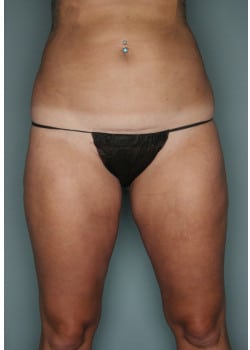 Liposuction