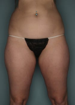 Liposuction