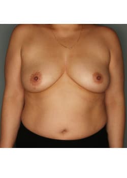 Mastopexy with Breast Augmentation