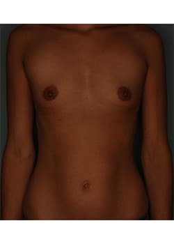 Bilateral Breast Augmentation