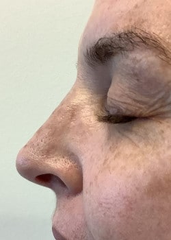 Non-Surgical Rhinoplasty