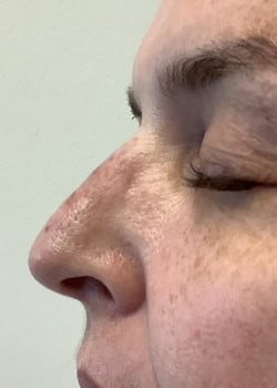 Non-Surgical Rhinoplasty