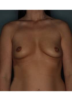 Bilateral Breast Augmentation