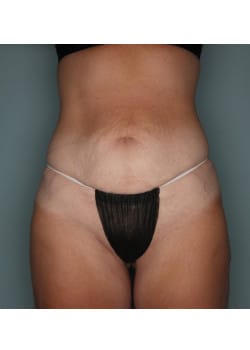 Abdominoplasty – Before & After – 2