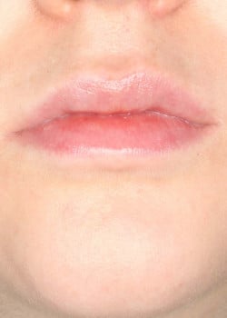 Lip Filler Treatment
