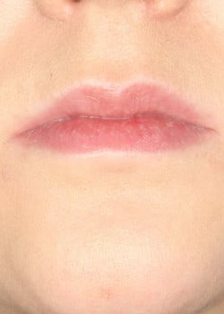 Lip Filler Treatment