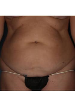 Abdominoplasty with Liposuction in Flanks