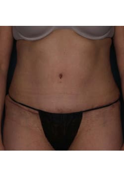 Abdominoplasty – Before & After – 1