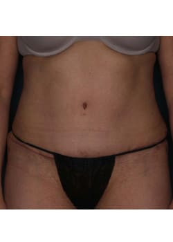 Abdominoplasty – Before & After – 1