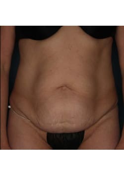 Abdominoplasty – Before & After – 1