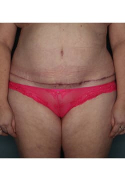 Abdominoplasty with Liposuction in Flanks and Upper Abdomen