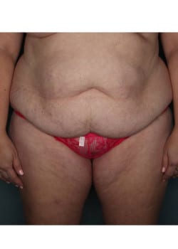Abdominoplasty with Liposuction in Flanks and Upper Abdomen
