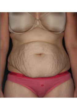 Abdominoplasty with Liposuction in Flanks