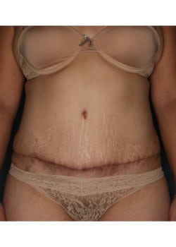 Abdominoplasty with Liposuction in Flanks and Upper Abdomen
