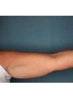 CoolSculpting to Upper Arm