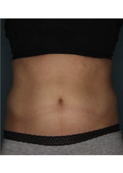 CoolSculpting to Upper and Lower abdomen
