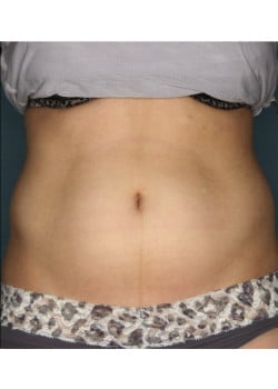 CoolSculpting to Upper and Lower abdomen