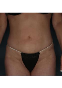 Liposuction to Abdomen and Hips