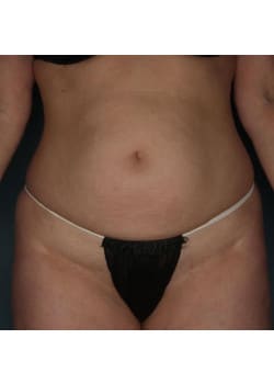 Liposuction to Abdomen and Hips