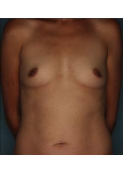 Bilateral Breast Augmentation