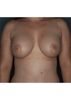 Bilateral Breast Augmentation