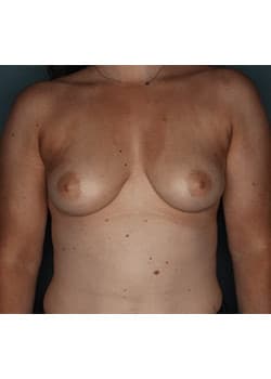 Bilateral Breast Augmentation